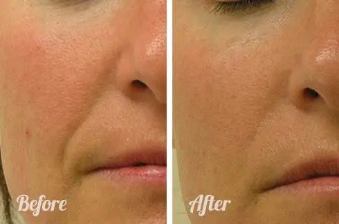 HydraFacial before and after results — deep cleansing facial at Estelworld Clinic London