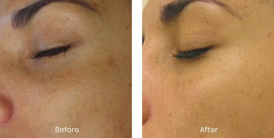 Before HydraFacial treatment at Estelworld