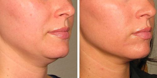 HIFU skin tightening before and after results — Estelworld Clinic London
