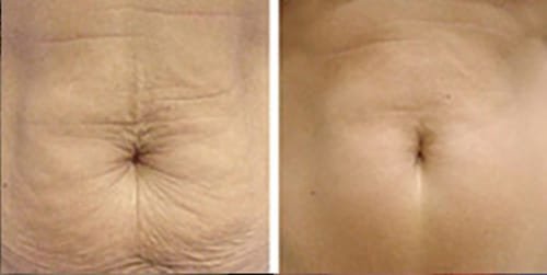 HIFU skin tightening before and after results — non-surgical facelift at Estelworld Clinic London