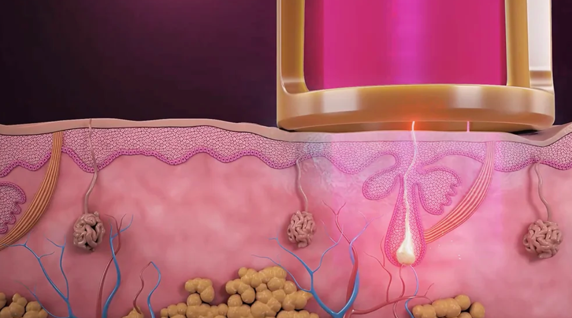 Alexandrite laser vs Nd:YAG laser skin diagram