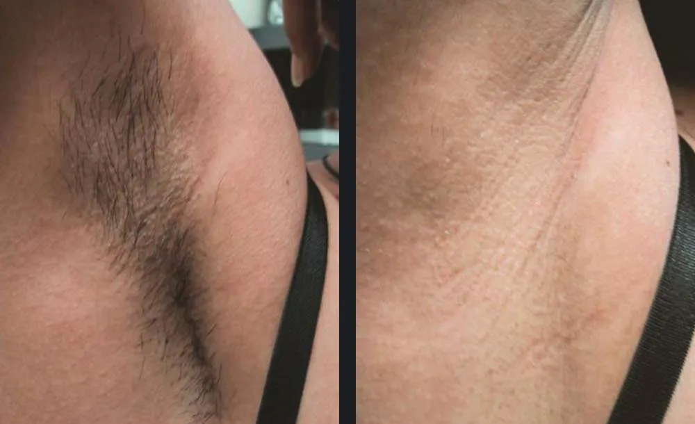 Underarm laser hair removal before and after