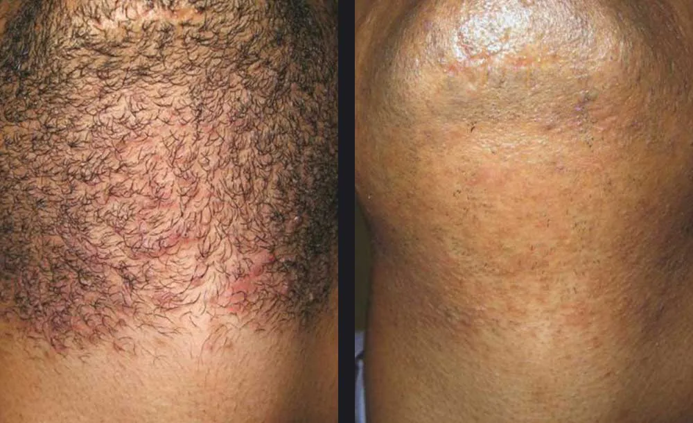 Men's under chin laser hair removal before and after