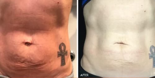 Men's HIFU before and after results at Estelworld Clinic London